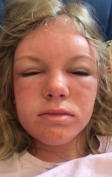 她忘了擦防曬就躺在太陽底下睡着了,起床後發現自己的臉嚴重浮腫。