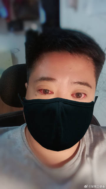 眼睛出現紅腫痕癢+大量分泌物,求醫後發現他眼睛已經被感染,患上「急性結膜炎」。