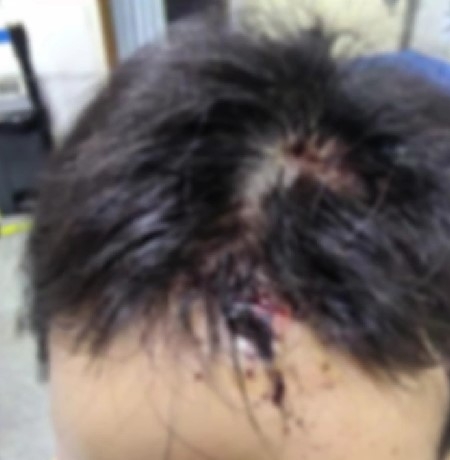 婚後僅過了2個月,就遭遇第一次家暴,被老公砍了2刀。