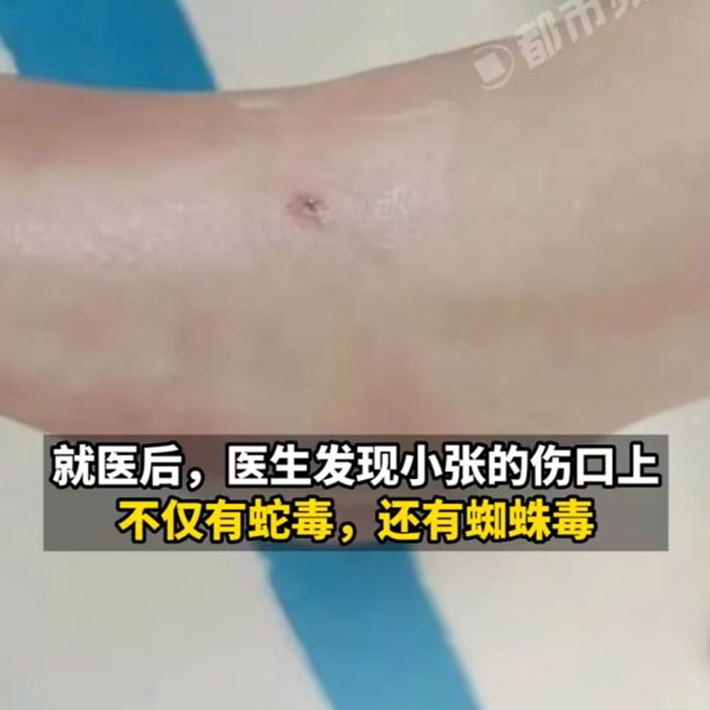 9歲女童在門外牽著小狗玩,卻誤踩到一個軟軟的物體,隨即就感到劇痛無比。
