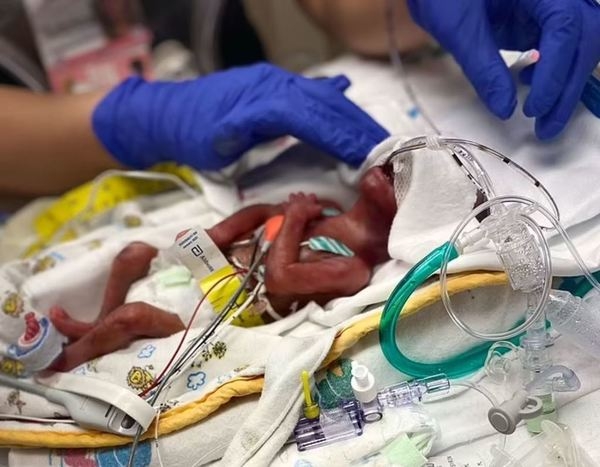 美國一名男嬰Eli James在去年3月早產出生,當時僅僅22週的他體重只有1磅。