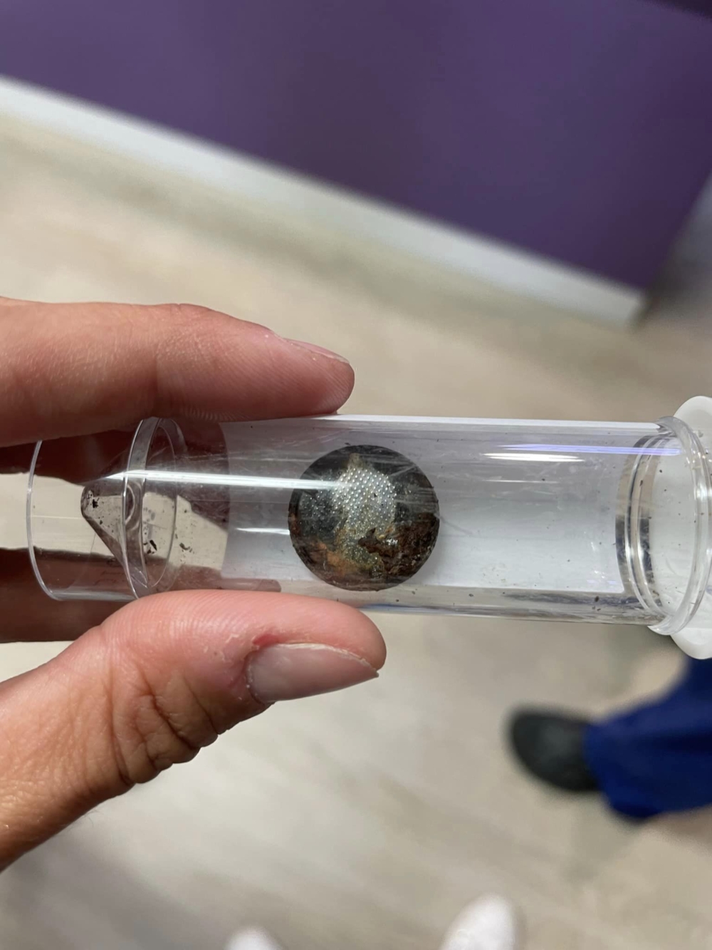 BB的食道裡卡著一粒紐扣型電池，而且電池已經把她的食道嚴重燒傷，情況危險。