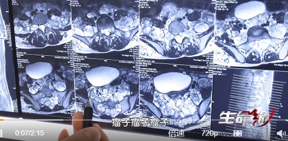 從X光片看起來,該女子身上幾乎被腫瘤充滿著體內。