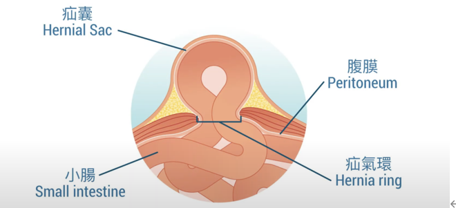 小腸氣即是疝氣, 腹腔內的器官多數是小腸或脂肪,經由腹腔壁的薄弱點,突出在表面形成腫脹。