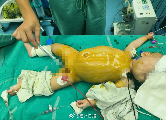 手術期間出現了5次因血壓、脈搏與血氧飽和度的問題而無法繼續被迫暫停手術，但所幸最終手術仍順利完成。