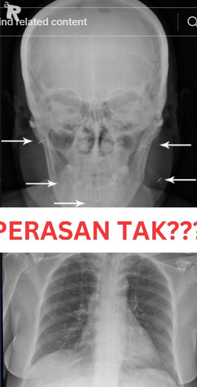 發現這名患者的眼睛、臉部、頸部與胸部等都有被植入的不明針體。
