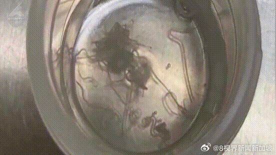 醫生經過檢查後,發現女子雙眼的眼珠表面與眼皮內都寄生了許多活體寄生蟲。