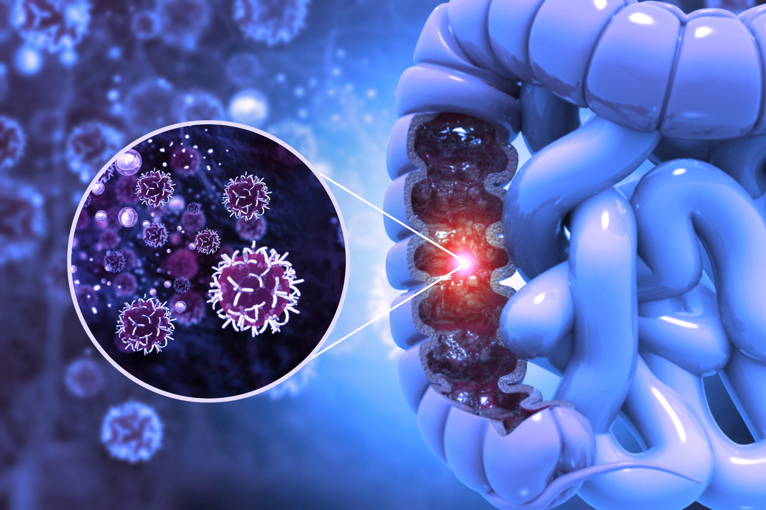 大腸癌腸阻塞是指由於大腸癌在腸道內生長形成腫瘤，進而阻塞腸道通常，從而影響正常的排便功能。