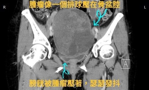 婦女抱怨連續兩個星期都有頻尿的現象,最終確診卵巢癌。