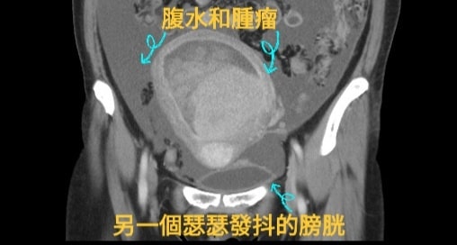 經過電腦斷層掃描後,才發現有個巨大的骨盆腔腫瘤,且再加上轉移導致腹水的情況出現。