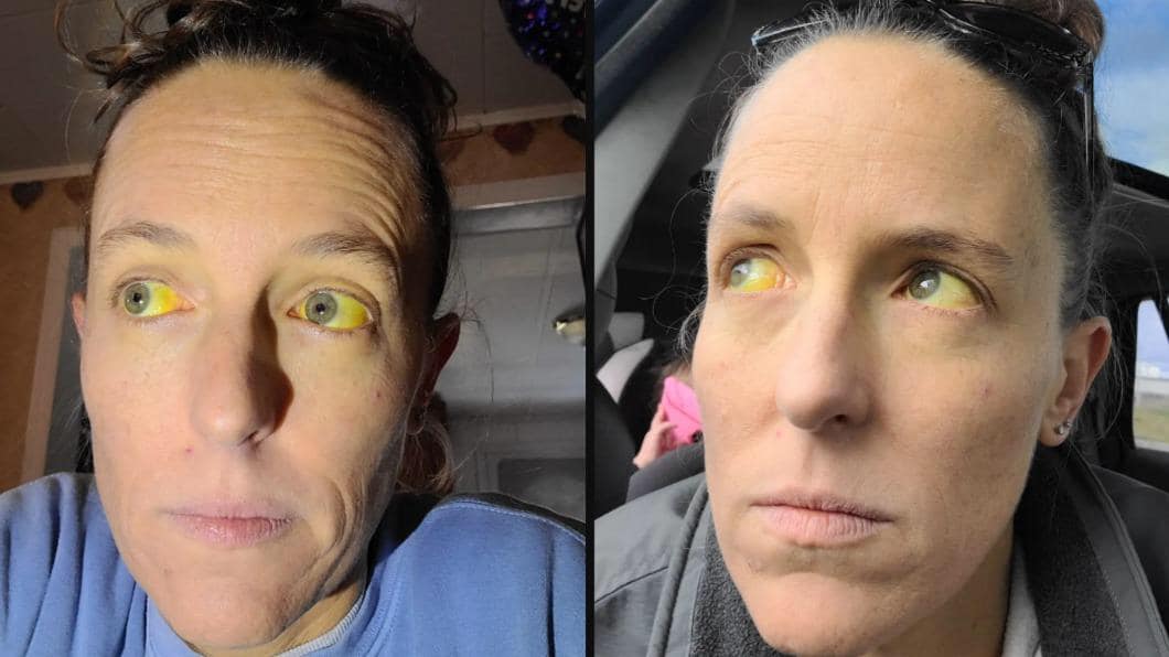 Amber持續服用了6周後，她開始出現胃痛，且症狀迅速惡化，隨後還發現她的皮膚與眼睛開始變成黃色。