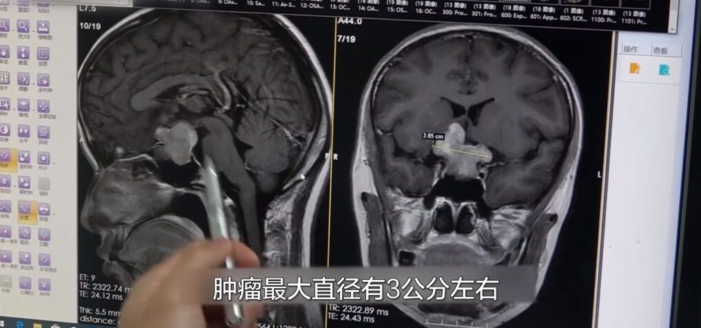 在進行腦部掃描檢查後,發現她的視神經與視交叉神經之間長了一個直徑3厘米大的垂體瘤。