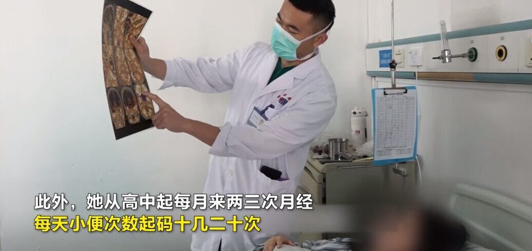 廣州21歲的女大學生小薇自高中開始,月經每個月會來2至3次與尿頻問題。