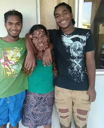 42歲女子Charmaine Sahadeo,因出生時就被診斷患有神經纖維瘤第1型,導致她在成長過程中也深受疾病困擾。