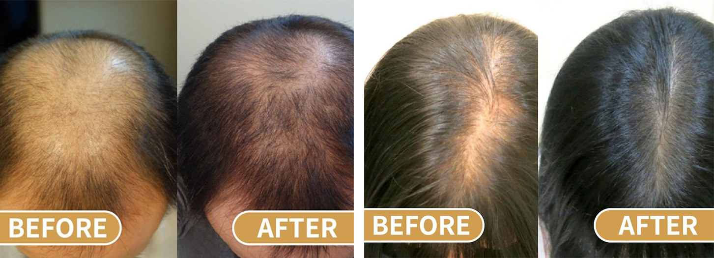 服用Kaminowa 法之羽生髮素3個月,髮線收窄,髮量增加。