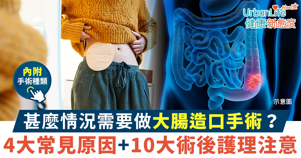 【大腸造口手術】甚麼情況要做腸造口?4大原因+護理注意事項