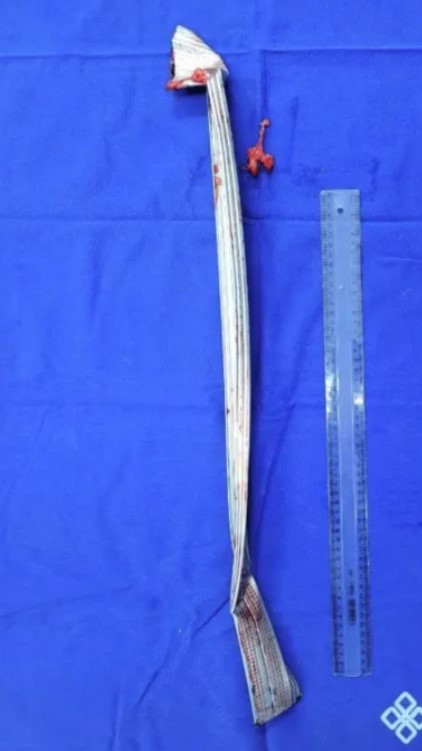 當時醫生在他身上開了從下腹到胸骨的開口，才順利的把鋼條取出來。