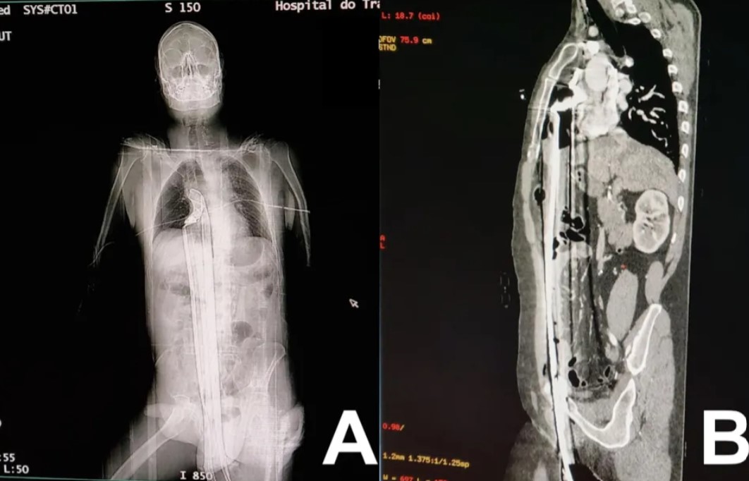 雖然該男子的肝臟已經被刺穿，但心律、血壓與血氧都穩定。