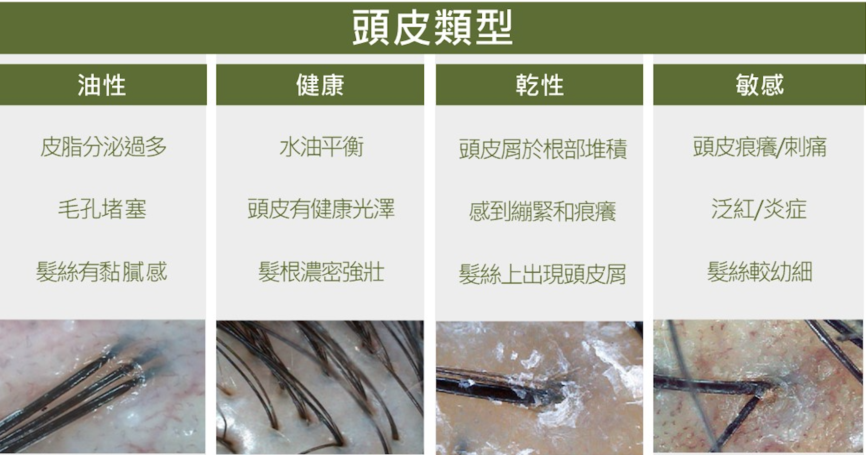 健康頭皮(左二)水油平衡,髮根粗壯,一個毛囊能長出數條頭髮,跟其他頭皮性質有明顯分別。油性頭皮(左一)油脂分泌過多,毛孔易受阻塞;乾性頭皮(右二)髮根易堆積頭皮屑,影響頭髮生長;敏感頭皮(右一)泛紅發炎,毛囊受損,髮絲明顯較幼,髮根稀疏,置之不理,將加速頭髮脫落。