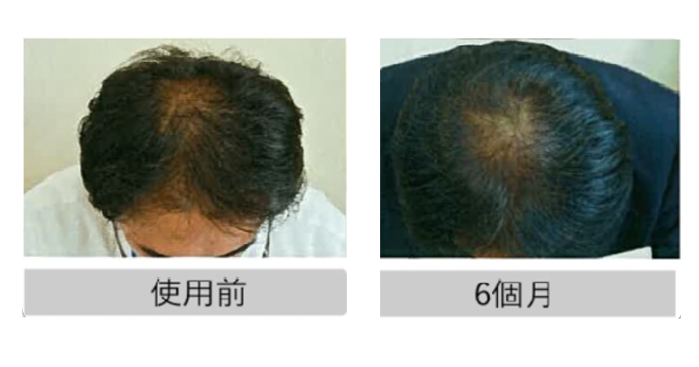 臨床實驗中多名用家連續使用6個月,見證成效顯著,不單守住髮量,更有明顯提升。