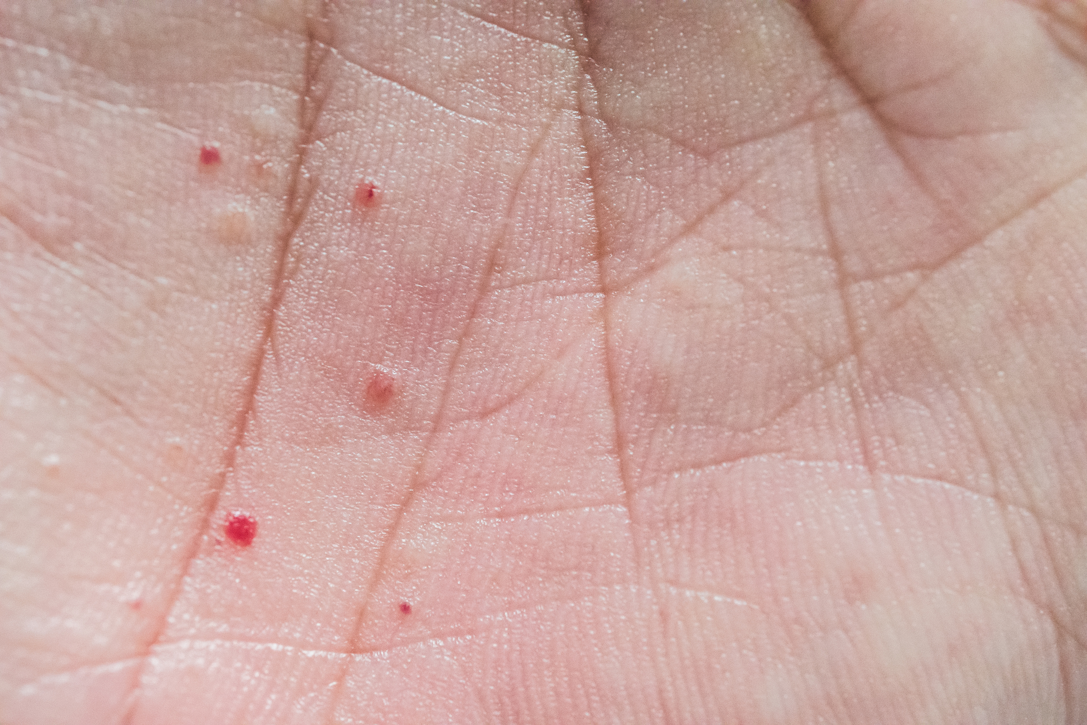 汗皰疹屬慢性濕疹的一種，故不具傳染性。主要好發位置在手指、手掌、腳掌，發作時皮膚會發炎痕癢、出水泡或丘疹，當水泡破掉後，患處就會開始脫皮，令皮膚變得乾裂。