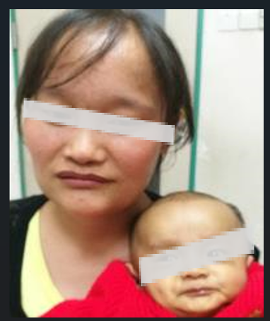 阿拉吉歐症候群常見於初生兒,初生數個月至1歲前發作