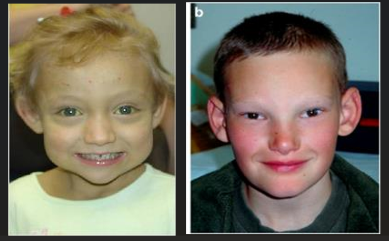 阿拉吉歐症候群(Alagille Syndrome,ALGS)是一種罕見的先天性肝臟疾病