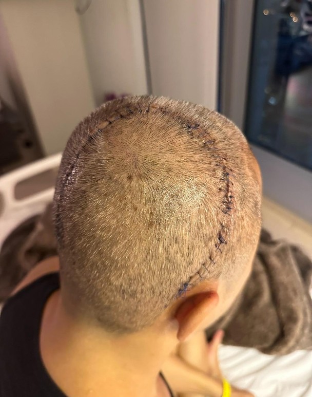 蔡一傑公布近照，可見他手術後頭顱背方留下一條長長的疤痕，令人震驚。