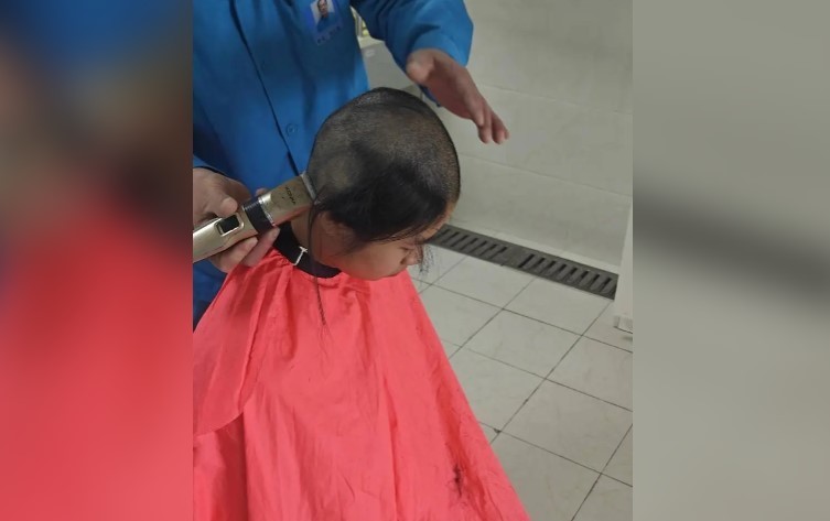 她剃光了一頭長髮後進行手術，頭皮被取成若干豆米粒大小的切塊。