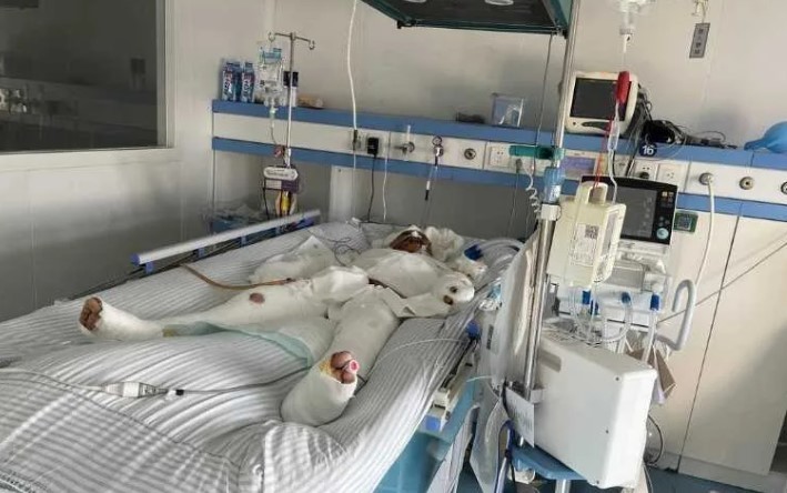 內地一名男子工作時慘遭鋼水燙傷，燙傷面積達95％性命垂危，急需以植皮方式治療創傷面。主診醫生表示，事主當時身上燙傷面積達95％，燙傷程度深二度、深三度，屬特重度燒傷，假如搶救不夠及時或治療不當恐造成生命危險。