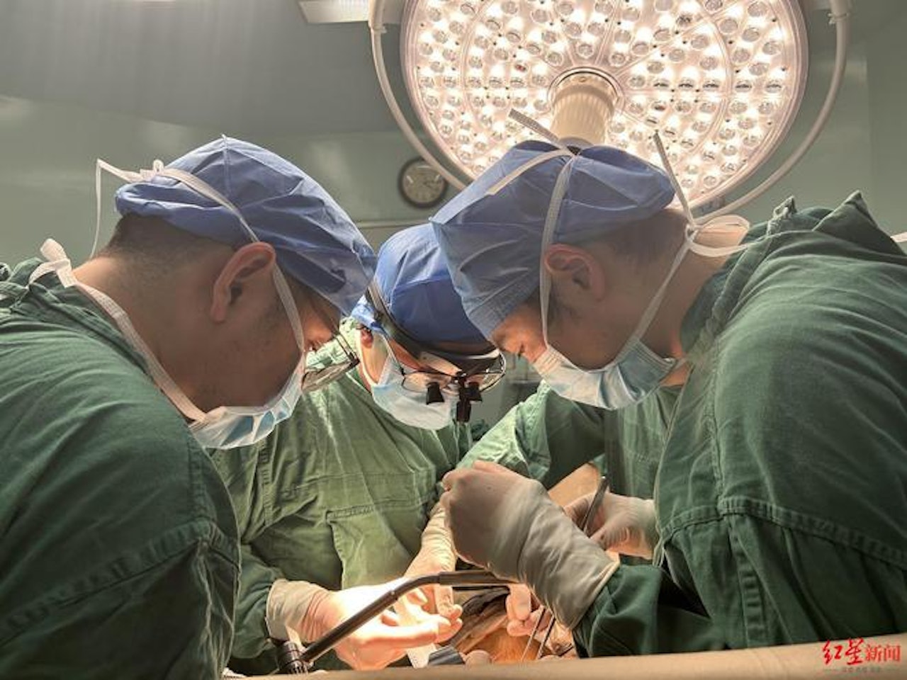 四川省人民醫院泌尿外科團隊近日成功為一名患有腎盂癌合併下腔靜脈癌栓的82歲老翁實施根治性手術，過程中利用了DeepSeek人工智能系統輔助制定詳盡方案。