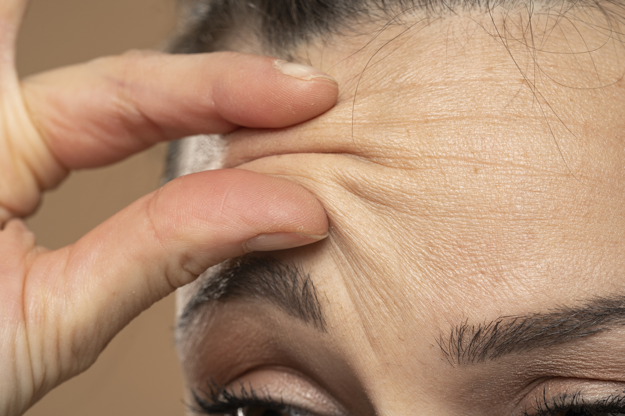 額頭皺紋又稱抬頭紋，主要分為：動態紋和靜態紋，兩者生成原因和改善方法各不相同。