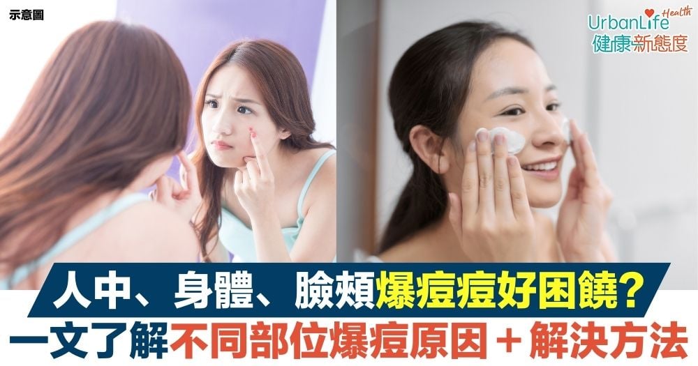 【癬種類】真菌所致?出汗多易生癬?乾癬、汗癬等7大皮膚癬分類