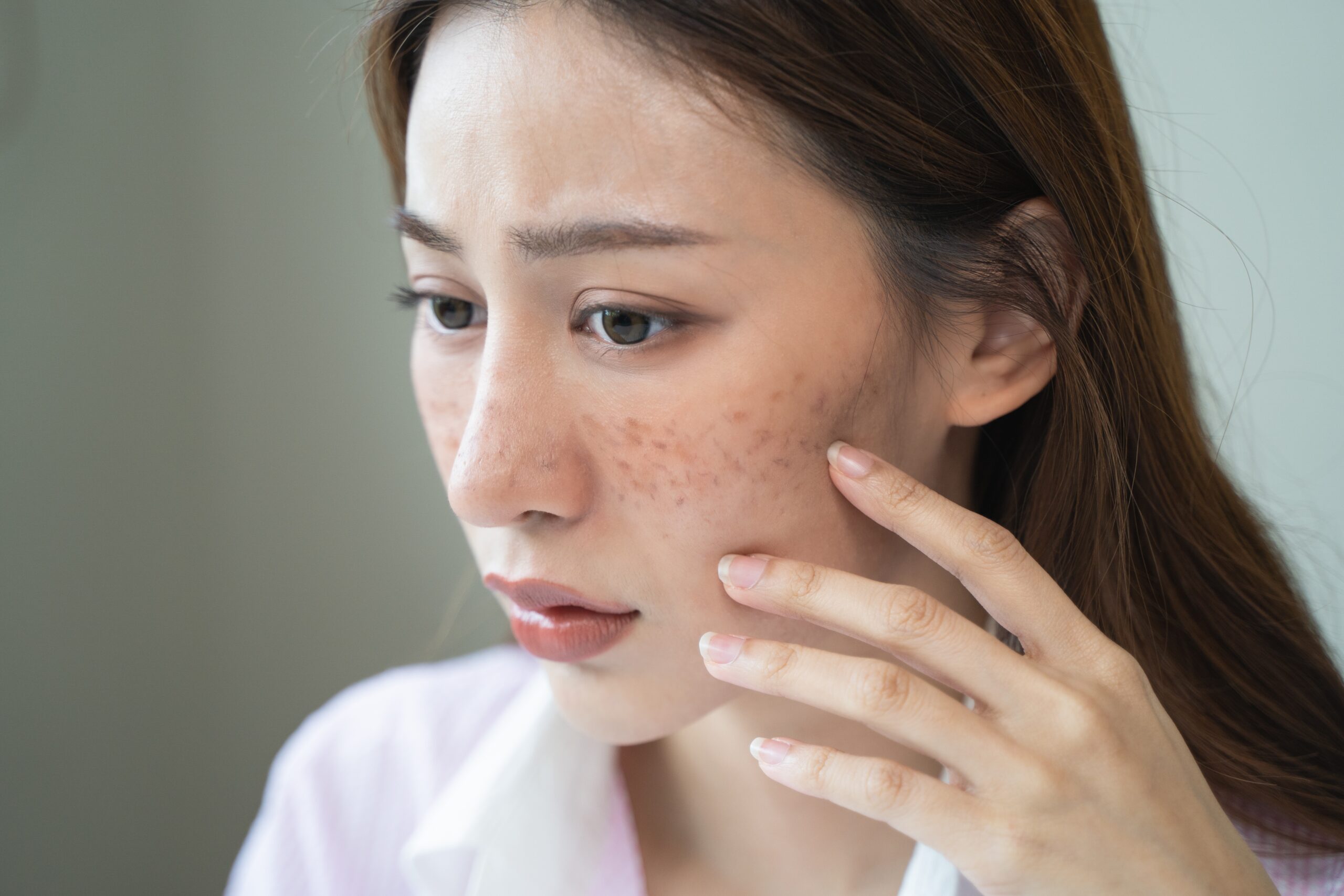 色斑很多人都面對的肌膚問題,了解斑點成因才能從根本上預防和改善!