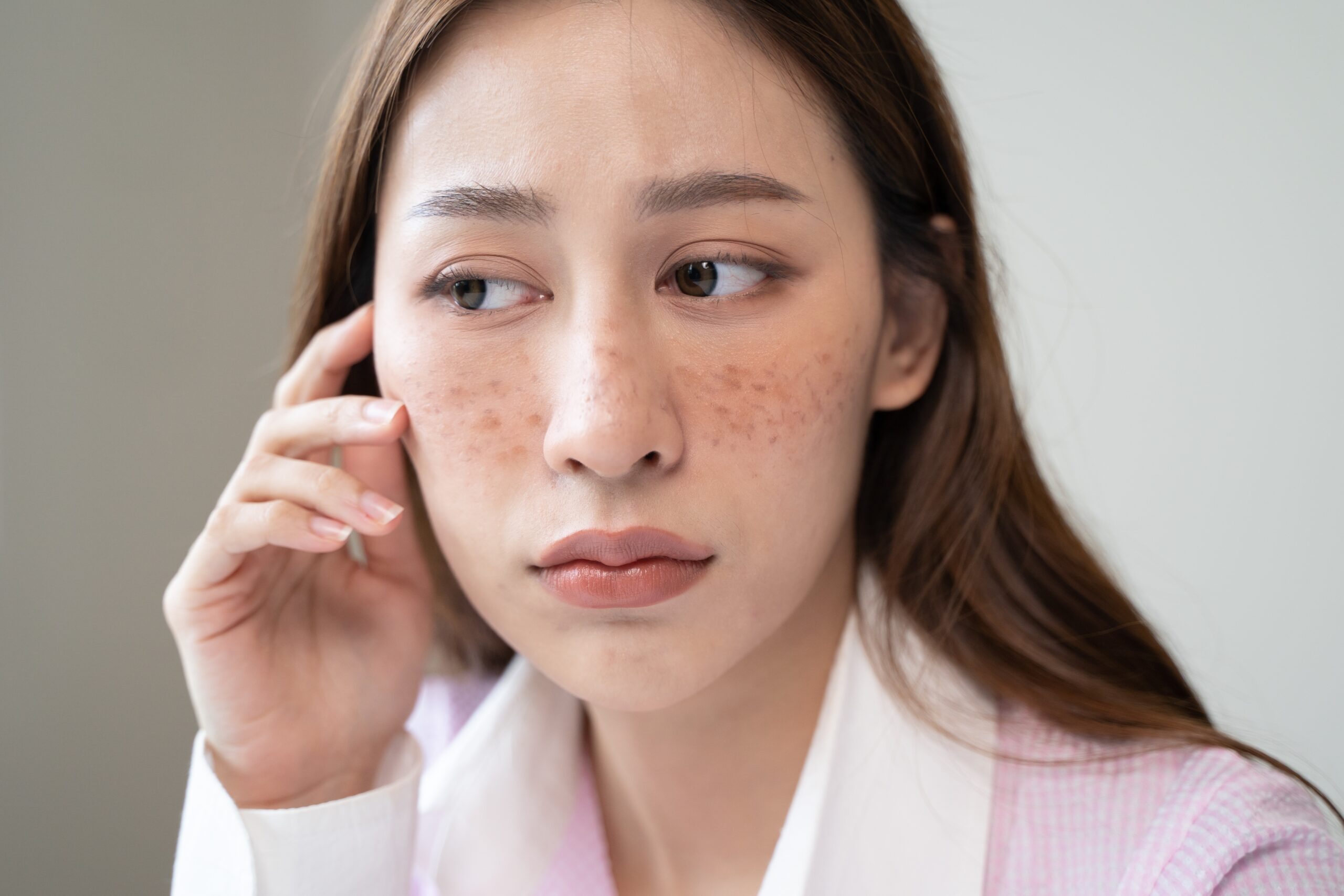 色斑根據黑色素分佈的深淺,分為「淺層色斑」和「深層色斑」。