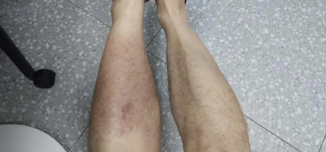 深圳新聞網早前報道,一名許姓男子在廣州遇暴雨,雙腳濕透後全日未有更換鞋襪,結果翌日竟高燒至40℃,左小腿出現紅腫疼痛,自行服藥無效後求醫,證實患上「丹毒」。