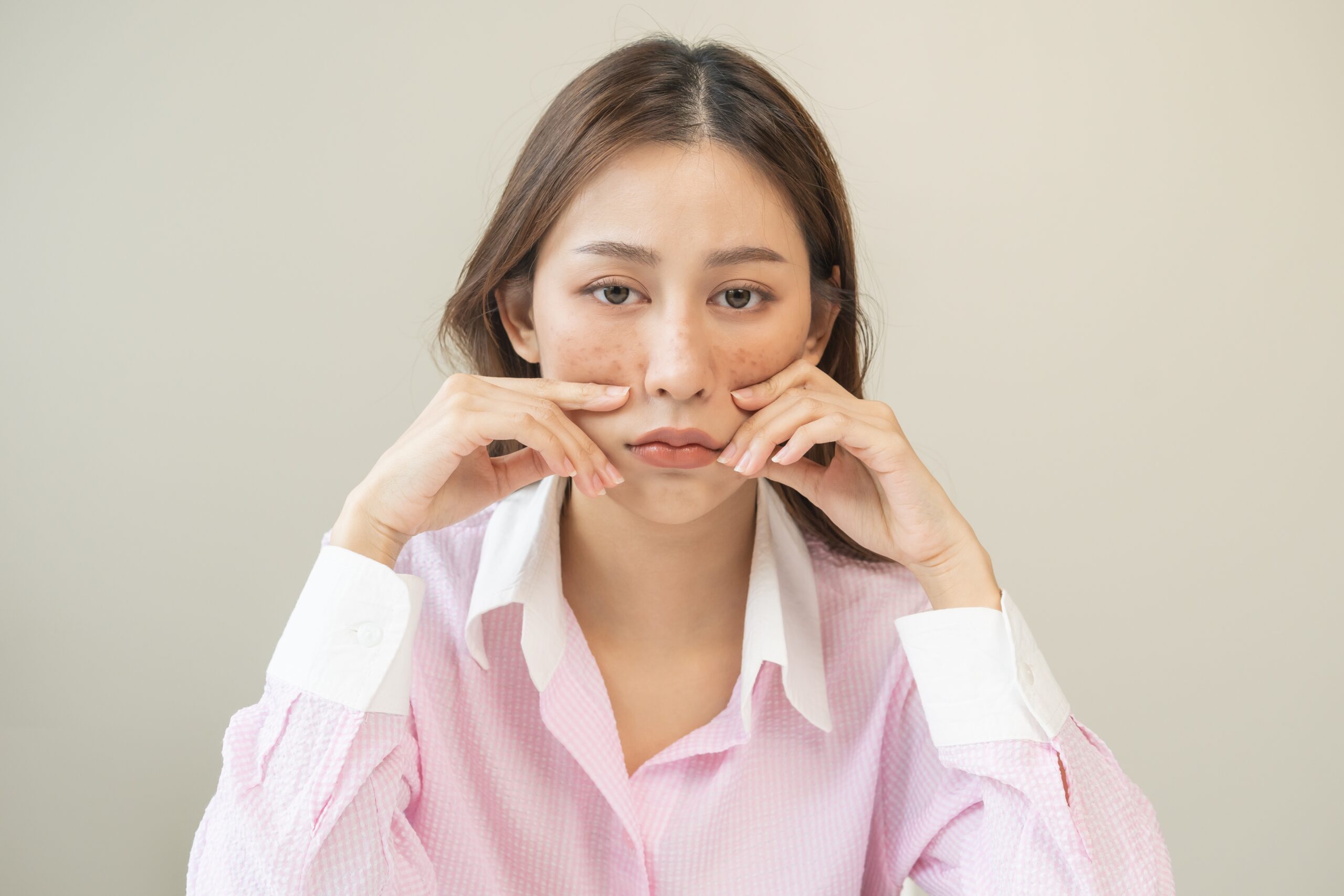 首先要辨識色斑的類型,因為不同色斑成因各異,適合的淡斑方法也不同。