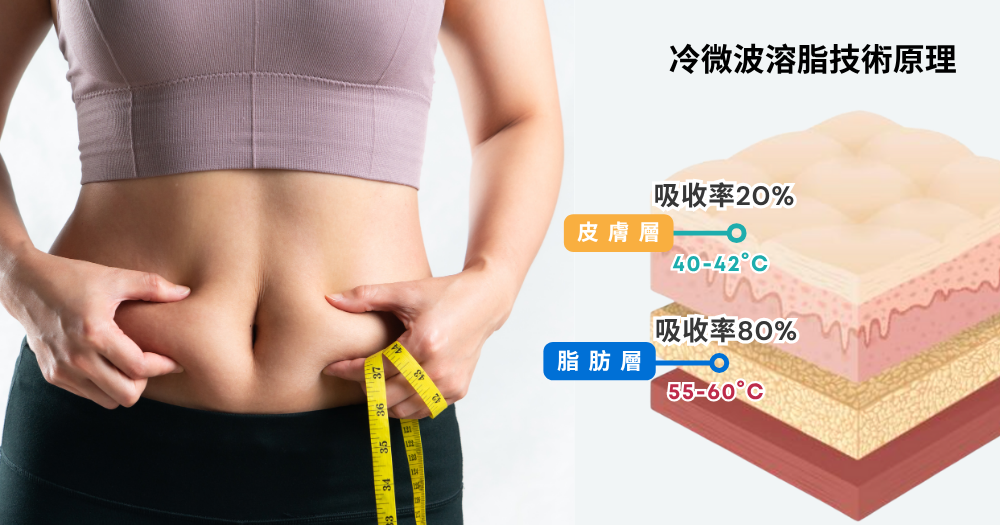 冷微波溶脂技術可將高頻能量精準聚焦於脂肪層