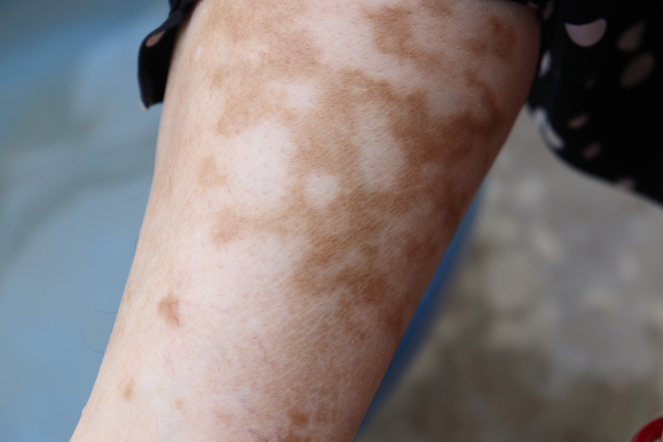 傳統療法各有其局限,例如長期使用類固醇可能導致皮膚變薄。