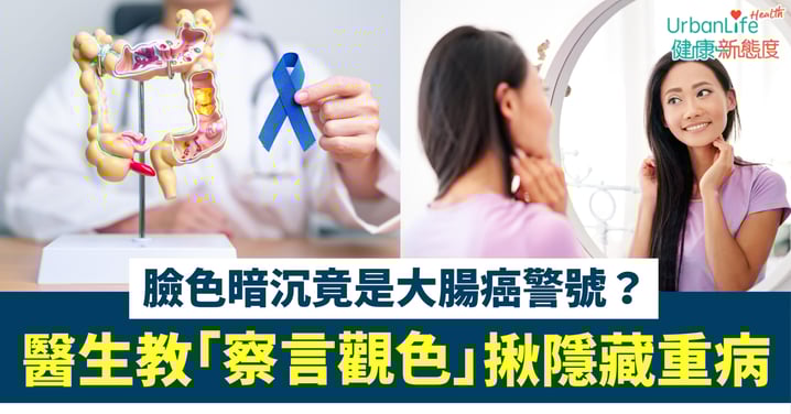 【患癌警號】臉色暗沉竟是大腸癌警號?腫瘤科醫生教你「察言觀色」 揪出隱藏重病
