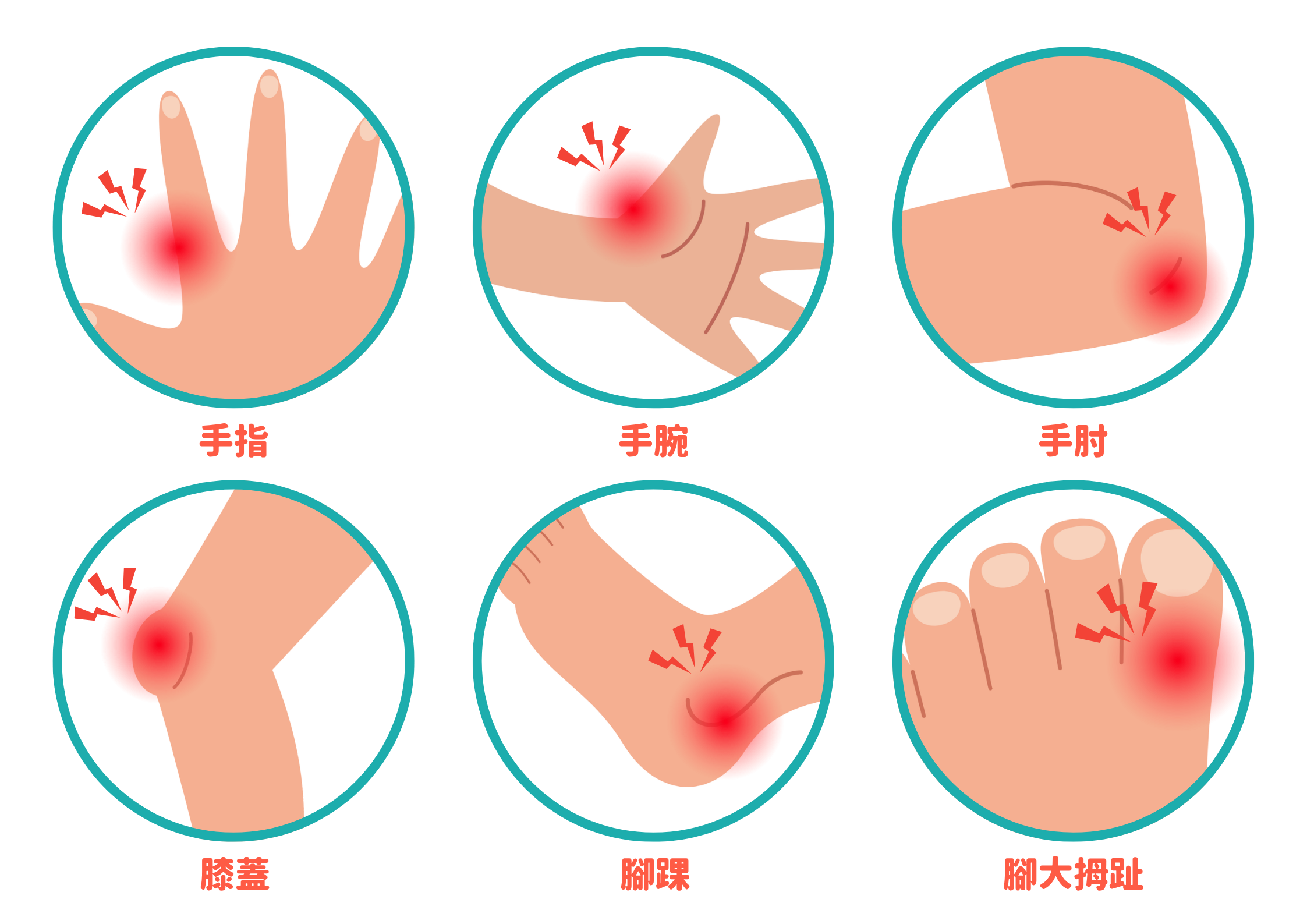 這些突如其來的酸、痺、刺、麻,甚至伴隨紅、腫、痛的感覺 ,都可能是體內尿酸水平超標的跡象 。