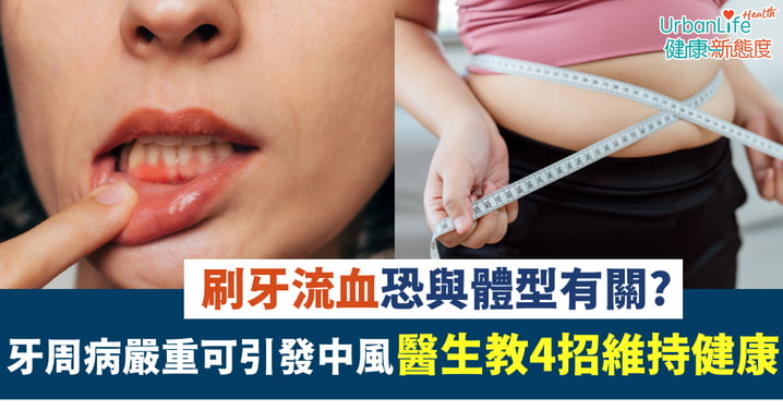 【牙齒護理】刷牙流血與體型有關?牙周病嚴重可引發中風 醫生建議4招維持健康