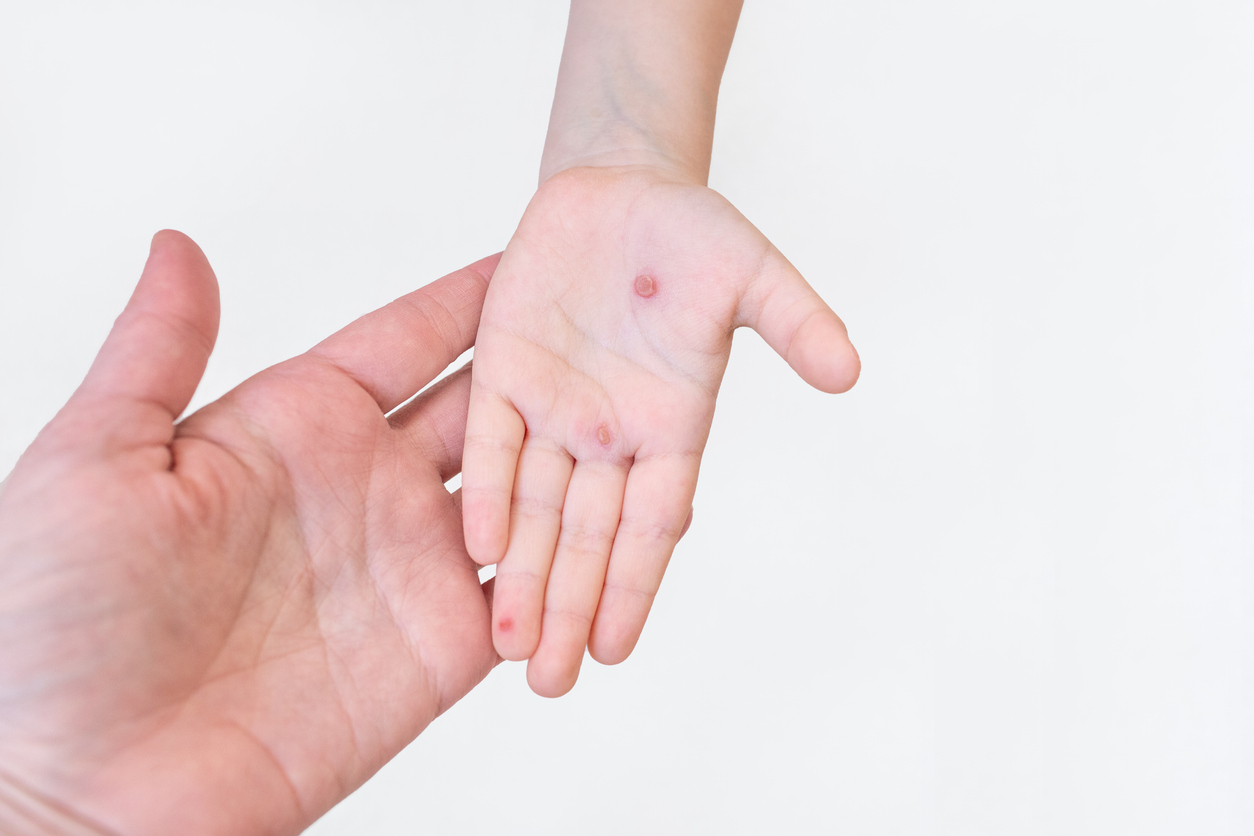 水泡如果護理得當(保留水泡皮、保持清潔),通常不會留疤;但若發生感染或反覆摩擦,則可能增加留下瘢痕或色素沉澱的風險。