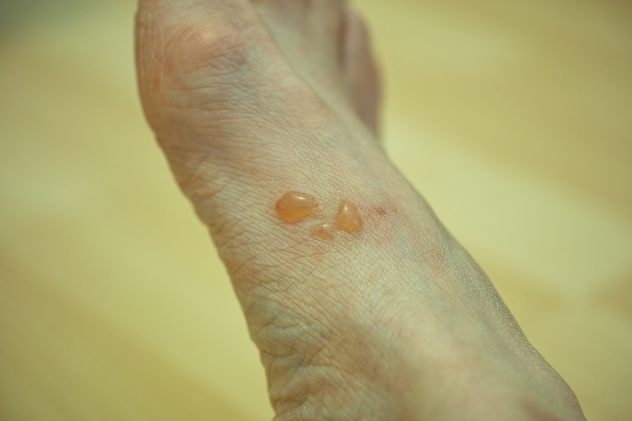 生水泡的主要成因包括鞋襪摩擦(最常見於腳底,因承重與摩擦大)、燙傷或曬傷等外部刺激與外傷,以及汗皰疹、香港腳或帶狀皰疹等皮膚疾病或病毒感染,其中腳底因承受全身重量與濕熱環境而特別容易發生。