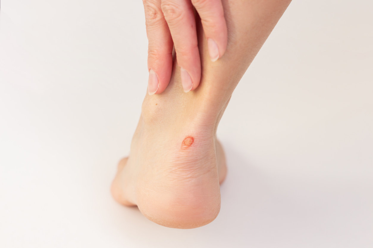 在保護得當且無感染的情況下,小型水泡通常在3至7天內自行消退,較大水泡約需7至14天,但疾病性水泡則需要配合治療,癒合時間可能長達數週。