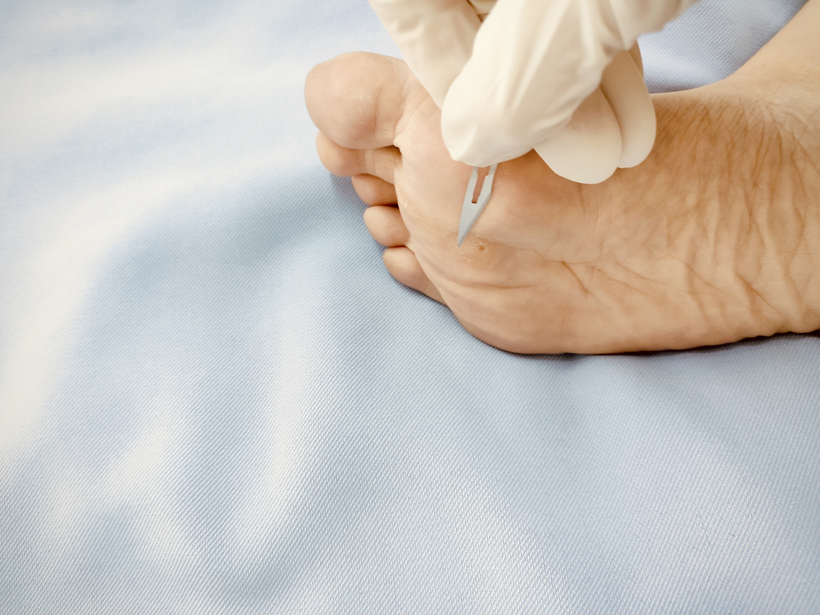 一般不建議自行刺破水泡,因為完整的水泡皮能作為天然保護膜阻擋感染並幫助癒合,但若水泡過大、極度疼痛或長在易摩擦處,可在徹底消毒後輕刺引流,並保留水泡皮覆蓋傷口。