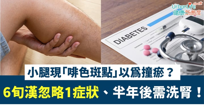 【糖尿病警號】小腿現「啡色斑點」以為撞瘀?6旬漢忽略1症狀、半年後需洗腎!