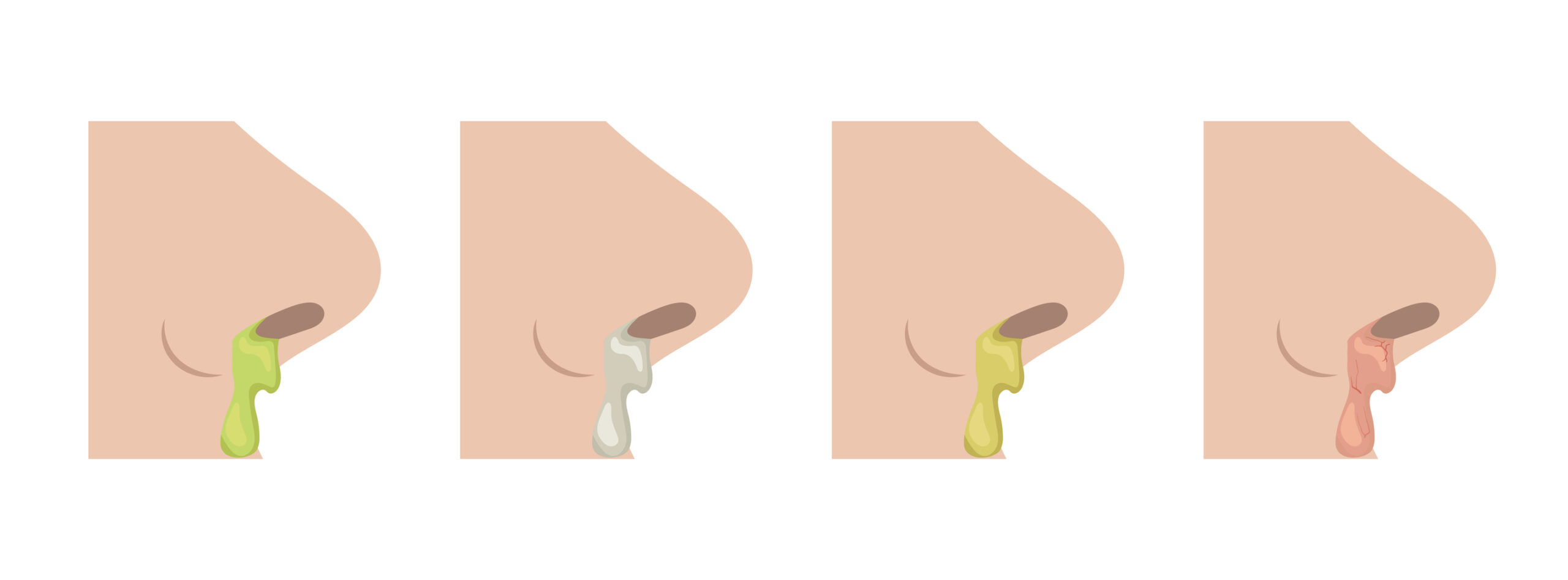 鼻涕顏色是身體的「六色密碼」，透明代表正常或過敏，黃綠色是免疫系統正在對抗感染，而粉紅/紅、金黃或黑色則可能分別代表微血管受損、真菌感染或污染物吸入，若顏色異常、持續不退或症狀加劇則應立即就醫。