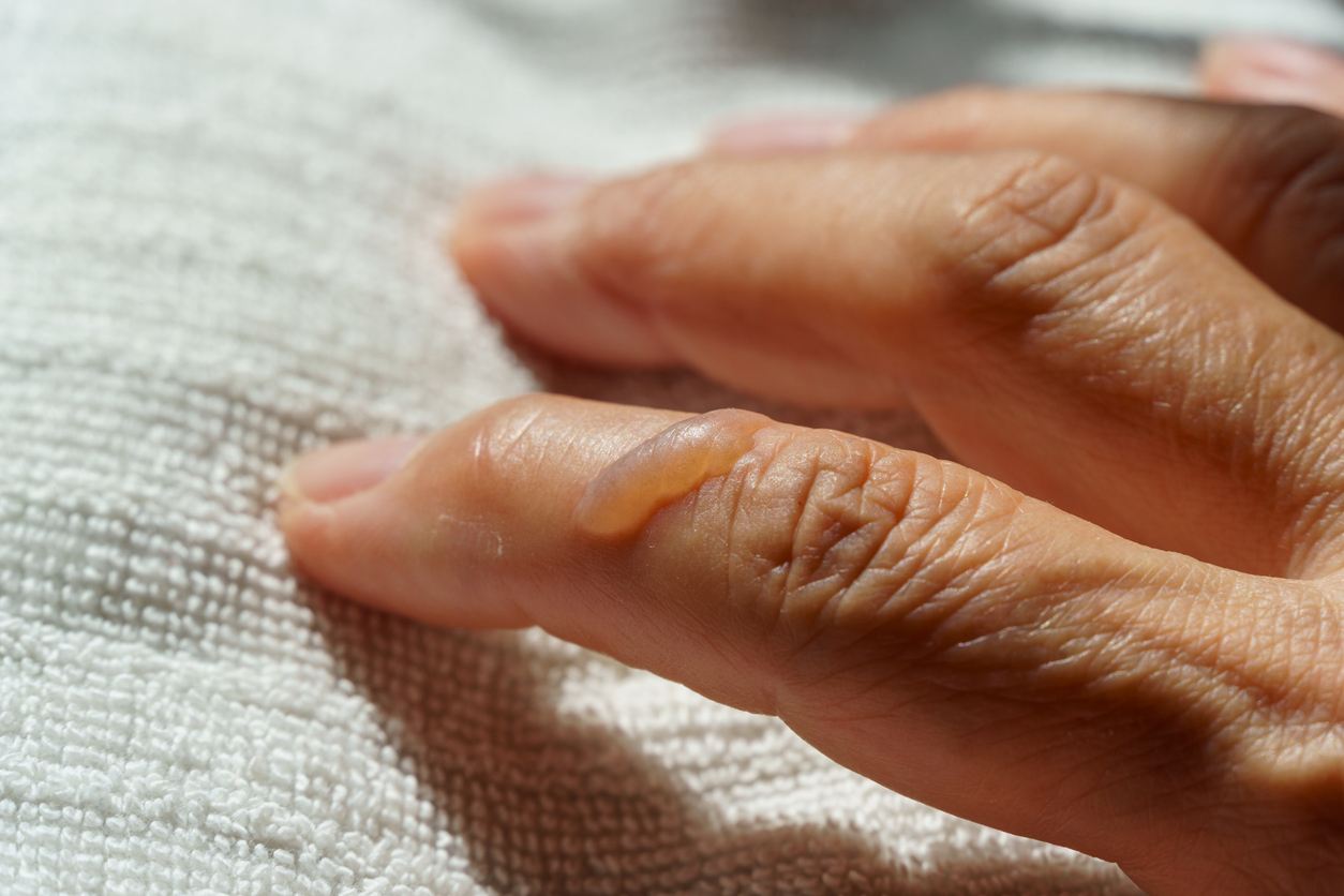 燙傷出現水泡時，切勿自行戳破，應保持完整或交由醫生處理；若水泡破裂，則需用生理食鹽水清洗、薄塗抗菌藥膏、並蓋上無菌敷料；同時嚴禁使用牙膏、醬油等偏方，並在傷口紅腫惡化時立即就醫。