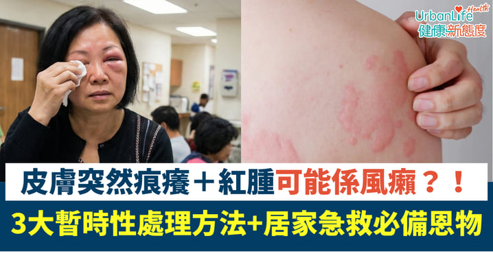 皮膚突然痕癢＋紅腫可能係風癩¹！蕁麻疹患者的3大注意事項¹！居家急救必備恩物
